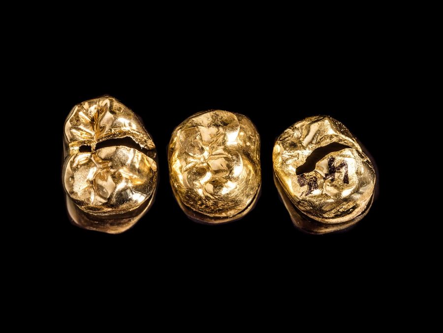 Zahngold als versteckte Ressource: Wie Altgold-Recycling Mittelstand, Rohstoffversorgung und Klimabilanz verbindet