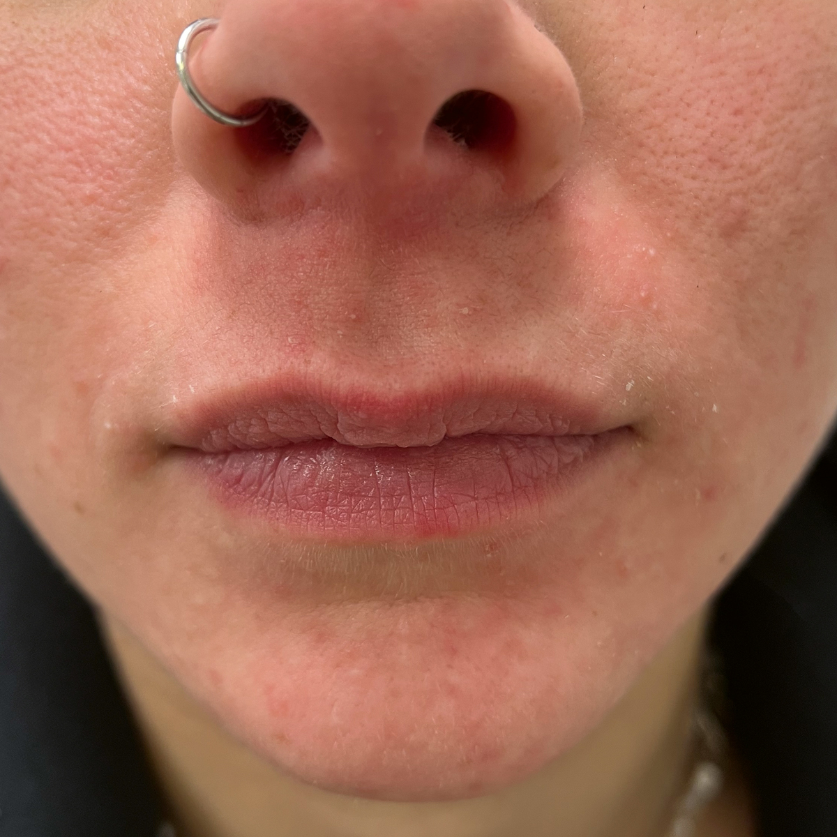 Periorale Dermatitis nach drei Sitzungen mit Kaltplasma Periorale Dermatitis nach drei Sitzungen mit Kaltplasma